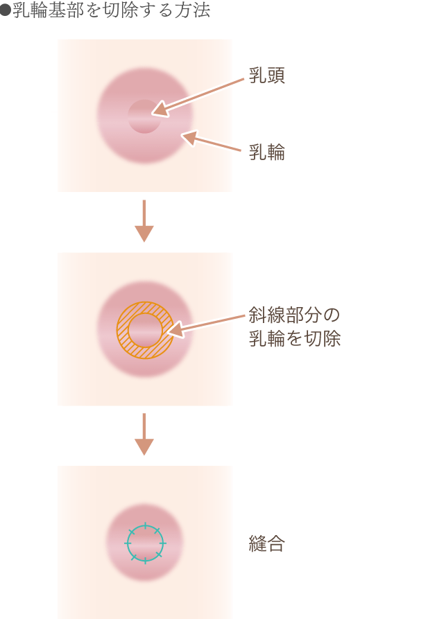 乳輪基部の切除方法の図