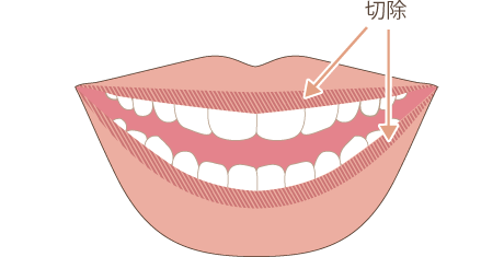 唇を薄くするの手術方法